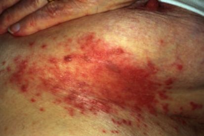 Cutaneous-Candidiasis-5