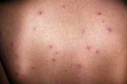 chickenpox-1