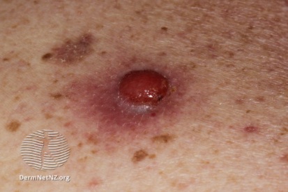 Melanoma-2